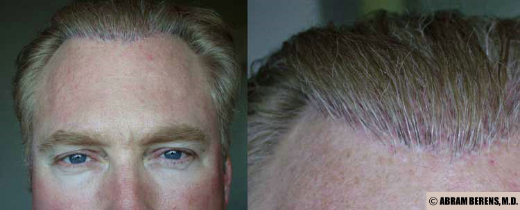 Hair Restoration in Fort Lauderdale